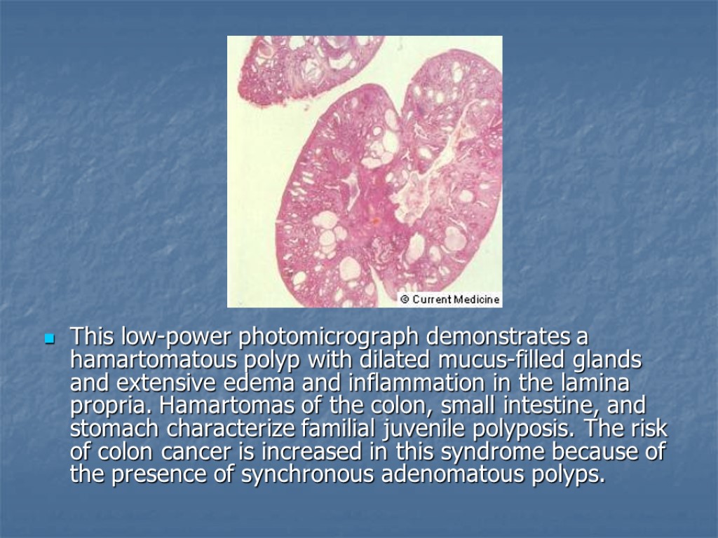 This low-power photomicrograph demonstrates a hamartomatous polyp with dilated mucus-filled glands and extensive edema
